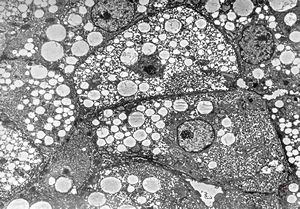 F,1y. | steatosis - Reye hepatocerebral syndrome F,1y. | steatosis - Reye hepatocerebral syndrome
